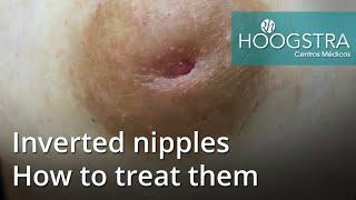 Inverted nipples -  How to treat them (20099)