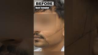 Beard Transplant in India Before & After Results | Get High Density & Full Volume beard