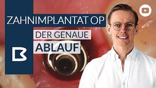 Zahnimplantat OP - Der genaue Ablauf