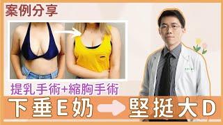 【提乳+縮胸手術｜真實見證】下垂𝐄奶→堅挺大𝐃  二寶媽：謝謝我的超人__整形外科 陳廣得醫師