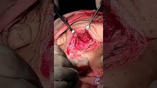 Pleomorphic Adenoma | Submandibular Gland Excision Surgery in ENT