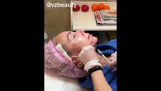 Векторный лифтинг препаратом Радиесс #beauty #радиесс
