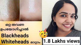 Blackhead Removal/Black Heads White Heads Removal/ How To Remove Blackheads At Home
