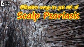 Scalp psoriasis:Symptom, Cause, Treatment | Safe ways to Wash Hair -Dr. Rasya Dixit| Doctors' Circle