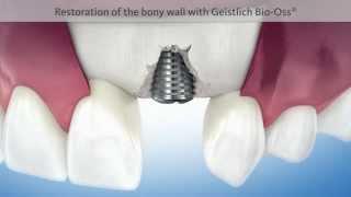 Repair Of Failing Dental Implant