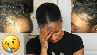 HOW I LOST MY HAIR AT 16!  NATURAL HAIR HORROR STORY