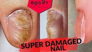 DAMAGED NAIL From Another Nail Tech  TWO Corrections In ONE Video