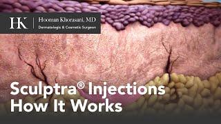 Sculptra® Injections for Collagen Growth - How It Works | Offered by Dr. Hooman Khorasani