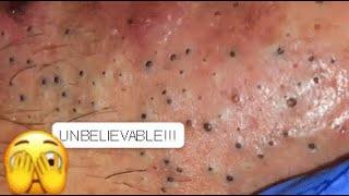 UNBELIEVABLE !!! A FACE FULL OF BLACKHEADS  YOU HAVE NEVER SEEN THIS BEFORE PART 2 #relaxing