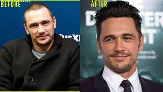 ONE OF THE BEST HAIR TRANSPLANT RESULTS EVER! (JAMES FRANCO)
