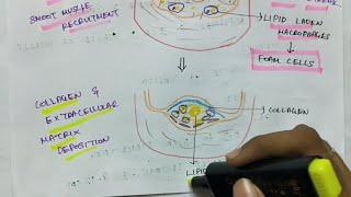 Atherosclerosis | Pathology | Handwritten notes