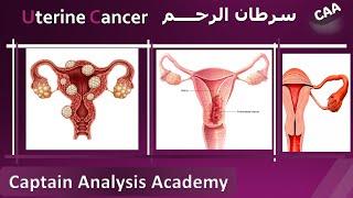 E4.Endometrial Cancer (Uterine cancer) سرطان الرحم اسبابة وطرق تشخيصة و علاجه