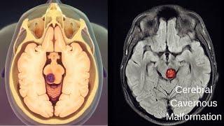 Cerebral Cavernous Malformation