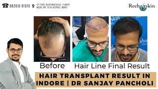 Hair Transplant Result In Indore | Dr Sanjay Pancholi is Best Doctor For hair transplant in Indore.