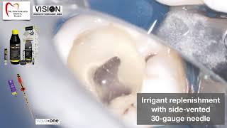 Mandibular Molar with 5 canals - Endodontic Treatment