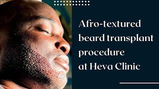 African American Beard Transplant in Turkey | Facial Hair Transplant Procedure at Heva Clinic