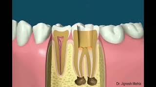 Root Canal Animation by Dr Jignesh Mehta