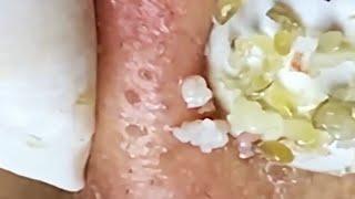 Blackheads & Whiteheads Satisfying Removal @001