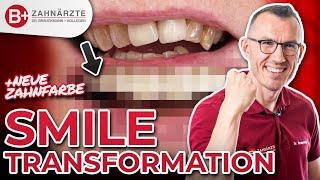 Smile Makeover mit Kronen - alte Zahnkronen raus, neues Lächeln rein!