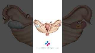 Time Lapse: Ectopic Pregnancy