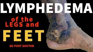 Lymphedema of the Legs and Feet and Associated Skin Conditions (Elephantiasis Nostra Verrucosa)