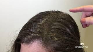 Scalp Camouflage For Hair Loss - Keratin Fiber