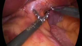Part 1 Live Gastric banding operation explained by Dr Craig Taylor OClinic SYDNEY
