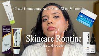 Oily, Acne-Prone Skin, Closed Comedones, Acne Marks & Dullness | Simple 4-Step Effective Routine