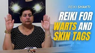 Reiki For Warts and Skin Tags