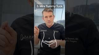 4 Types Of Tummy Tucks! 