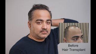 Harris Shares His Hair Transplant Experience | Dr Mark Tam