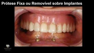 Implante Dentário - Prótese Fixa ou Removível ?