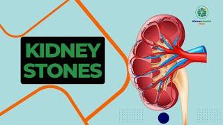 Understanding and Managing Kidney Stones: Symptoms, Causes, and Treatments