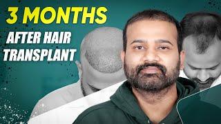 Hair Transplant in Chandigarh | Best Results & Cost of Hair Transplant in Chandigarh