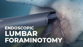 What is Endoscopic Lumbar Foraminotomy? | @Atlantic Spine Center