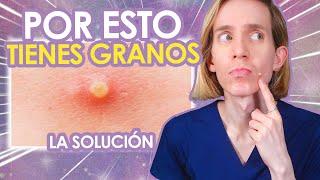 5 RAZONES por las cuales TE SALEN GRANITOS - Como SOLUCIONARLAS - Simon Scarano Dermatologo