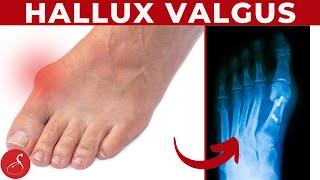 Hallux Valgus ganz einfach loswerden │ SanoGym