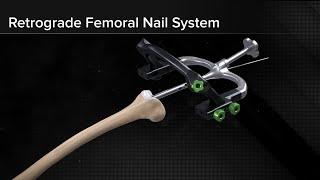 Retrograde Femoral Nail System Surgical Technique