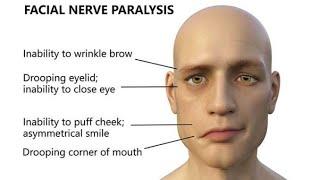 Research Links Covid-19 Vaccines to Facial Paralysis