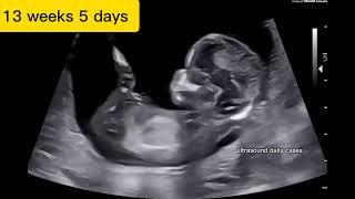 beautiful Ultrasound video showing active baby at 13 weeks 5 days #ultrasound #babyboy #obstetrics