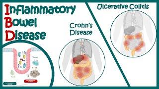 Inflammatory Bowel Disease - Crohns disease and Ulcerative Colitits | Animated biology with Arpan