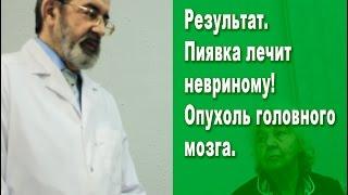 Результат. Пиявка лечит невриному! Невринома. Опухоль головного мозга, сколько с ней живут?