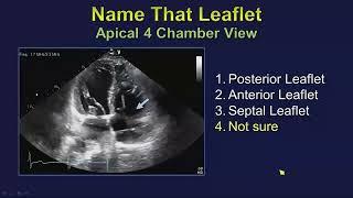 Echo Assessment of Tricuspid Valve Regurgitation