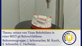 Zahntechnik-Konventionell-setzen von Titan-Bohrhülsen in einer MED-3D Bohrschablone