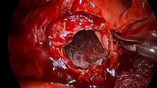 Transabdominal and Transvesical Laparoscopic Vesico Vaginal Fistula Repair