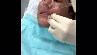 Lip Filler Treatment by Dr. Steven Yarinsky, MD, FACS - Expert Injector