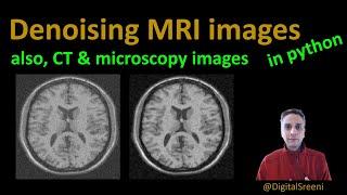94 - Denoising MRI images (also CT & microscopy images)