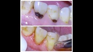 [16] Repair of tooth decay at gumline