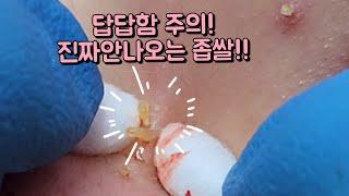 좁쌀 여드름 압출 동영상, 고구마 100개 먹는줄~!!