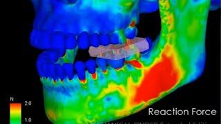 Quantitative CT-based Finite Element Analysis of Mastication